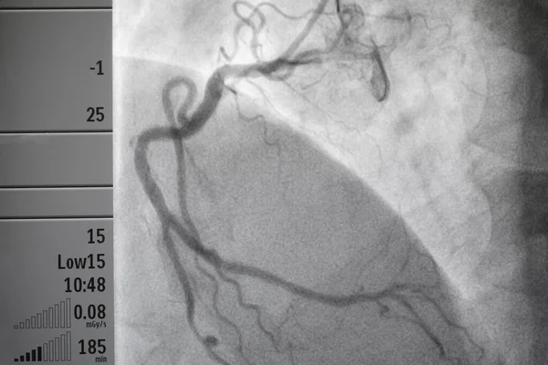 Coronary angiography , left and right coronary angiography