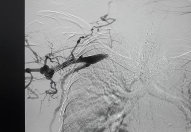 EVAR prosedürü sırasında infra renal abdominal aortik anevrizmada aort grefti uygulandıktan sonra anjiyogram sağ kalça atardamarı..