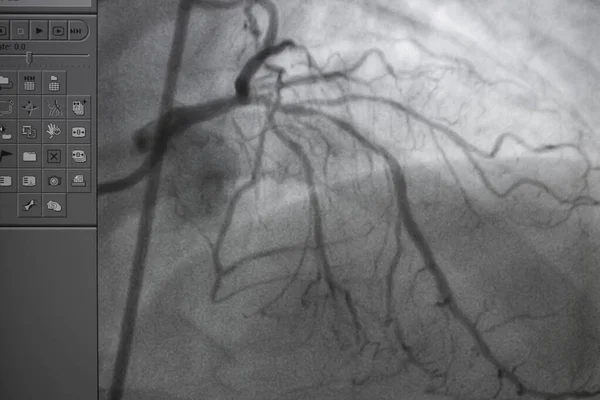 Koronarangiogramm Medizinisches Röntgen Bei Herzkrankheiten Koronare Herzkrankheit — Stockfoto