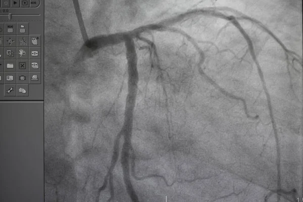 Коронарная Ангиограмма Медицинский Рентген Сердечных Заболеваний Болезнь Коронарных Артерий — стоковое фото