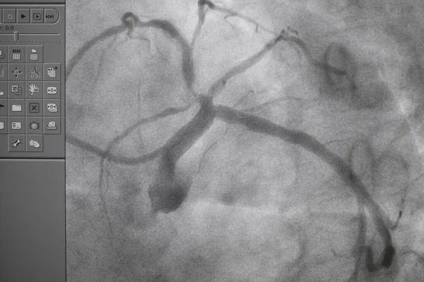 冠血管造影 心臓病のための医療X線 冠動脈疾患 — ストック写真