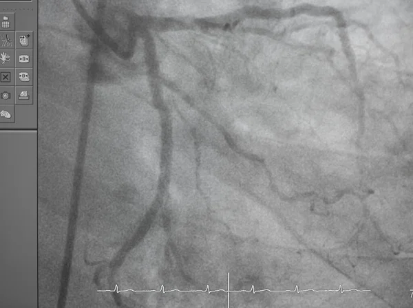 冠状动脉造影 治疗心脏病的医学X光检查 冠状动脉疾病 — 图库照片