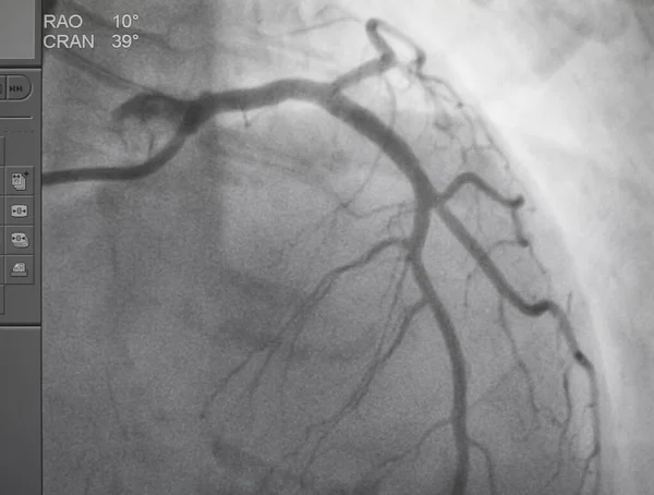 Angiograma Coronário Raio Médico Para Doenças Cardíacas Doença Arterial Coronária — Fotografia de Stock