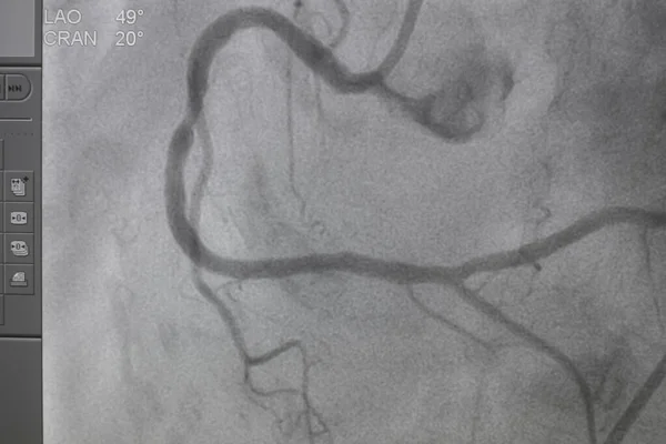 Koroner Anjiyogram Kalp Hastalığı Için Tıbbi Röntgen Koroner Arter Hastalığı — Stok fotoğraf
