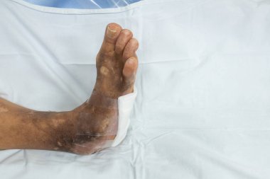 Diyabetik ayağın enfeksiyon kapmış. Diyabet belirtileri