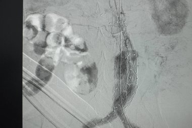 X-ray görüntüsü. EVAR sırasında, infra renal abdominal aort anevrizmasında, aortik stent grefti uygulandıktan sonra, sağ kalça atardamarının anjiyogramı. 