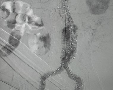 X-ray görüntüsü. EVAR sırasında, infra renal abdominal aort anevrizmasında, aortik stent grefti uygulandıktan sonra, sağ kalça atardamarının anjiyogramı. 