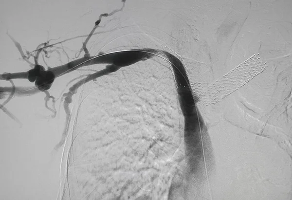 X光图像 腹主动脉置换术后肠系膜右共同动脉血管造影 Evar 在肾内腹主动脉瘤中的应用 — 图库照片
