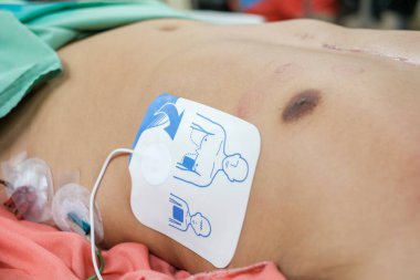 Otomatik dış defibrilatör ve vitesli. Hayati tehlikesi olan kardiyak aritmileri otomatik olarak teşhis eden taşınabilir bir elektronik cihaz..