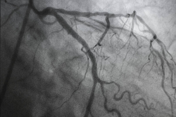 Коронарная ангиография, ишемическая болезнь. Медицинский рентген сердечных заболеваний. Здравоохранение и медицина.