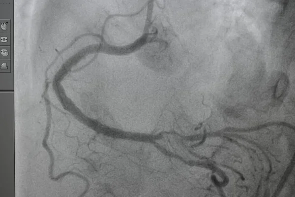 Coronary angiography, Coronary artery disease. Medical x-ray of heart disease. Healthcare and medical concept.