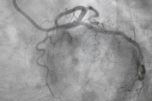 Coronary angiography, Coronary artery disease. Medical x-ray of heart disease. Healthcare and medical concept.