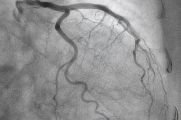 Coronary angiography, Coronary artery disease. Medical x-ray of heart disease. Healthcare and medical concept.