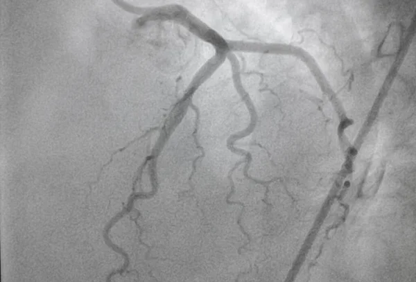 Angiografía Coronaria Enfermedad Arterial Coronaria Radiografía Médica Enfermedades Cardíacas Salud — Foto de Stock