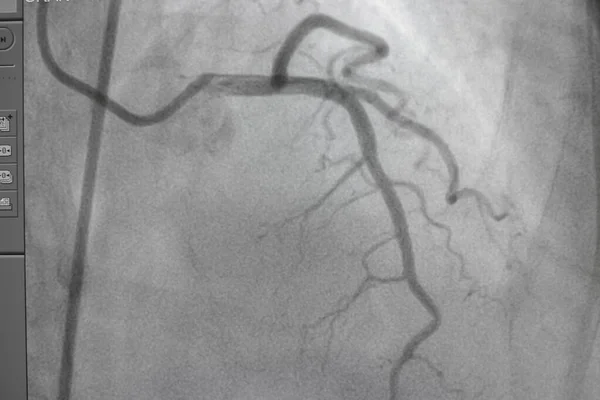 Coronary angiography, Coronary artery disease. Medical x-ray of heart disease. Healthcare and medical concept.