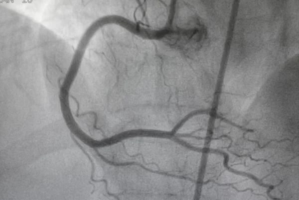Angiografia Coronária Doença Arterial Coronária Radiografia Médica Doenças Cardíacas Conceito — Fotografia de Stock