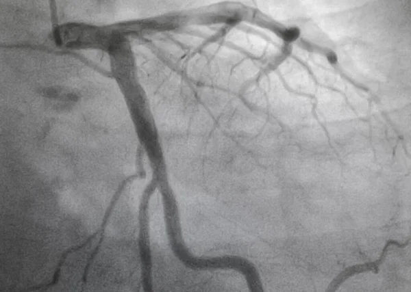 Coronary angiography, Coronary artery disease. Medical x-ray of heart disease. Healthcare and medical concept.