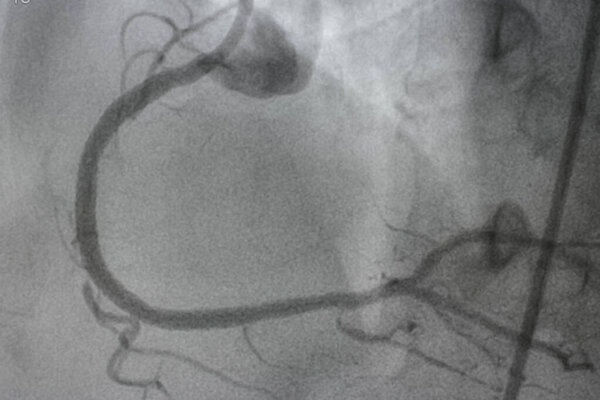 Коронарная ангиография, ишемическая болезнь. Медицинский рентген сердечных заболеваний. Здравоохранение и медицина.