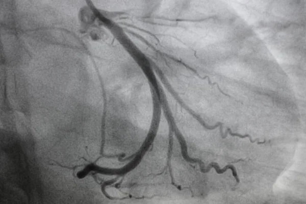 Koronarangiographie Koronare Herzkrankheit Medizinische Röntgenaufnahme Von Herzerkrankungen Gesundheitswesen Und Medizinisches — Stockfoto