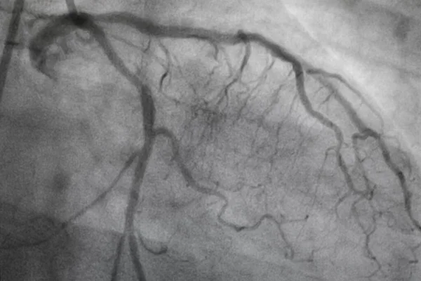 Koronarangiographie Koronare Herzkrankheit Medizinische Röntgenaufnahme Von Herzerkrankungen Gesundheitswesen Und Medizinisches — Stockfoto