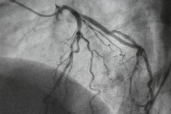 Angiografia Wieńcowa Choroba Wieńcowa Prześwietlenie Medyczne Choroby Serca Opieka Zdrowotna — Zdjęcie stockowe