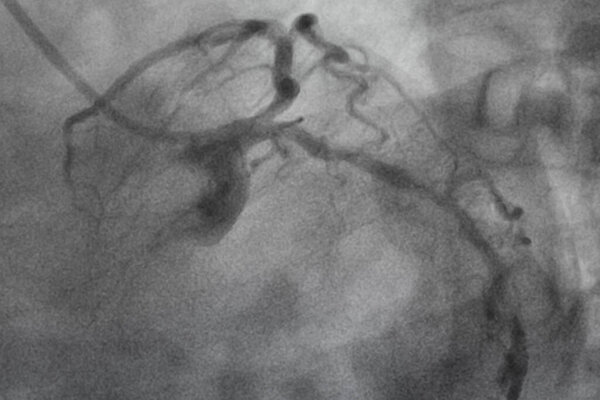 Коронарная ангиография, ишемическая болезнь. Медицинский рентген сердечных заболеваний. Здравоохранение и медицина.