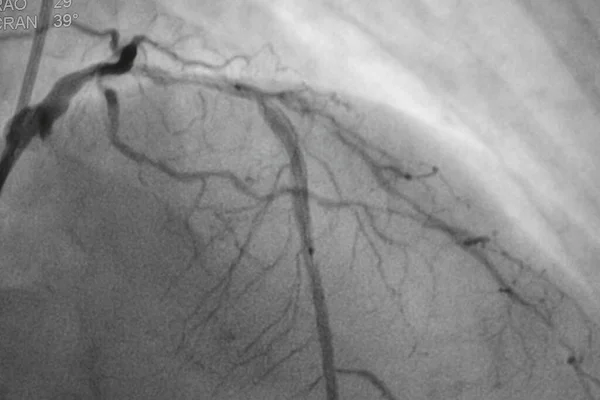 Coronary angiography, Coronary artery disease. Medical x-ray of heart disease. Healthcare and medical concept.