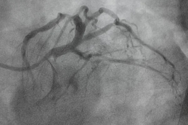 冠状动脉造影 冠状动脉疾病 心脏病的医疗X光检查 保健和医疗概念 — 图库照片