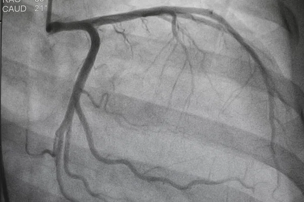 Coronary angiography, Coronary artery disease. Medical x-ray of heart disease. Healthcare and medical concept.