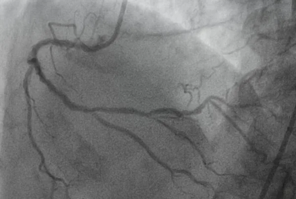 Coronary angiography, Coronary artery disease. Medical x-ray of heart disease. Healthcare and medical concept.