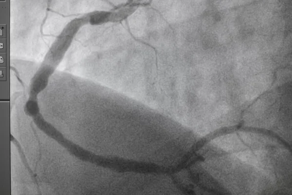 Coronary angiography, Coronary artery disease. Medical x-ray of heart disease. Healthcare and medical concept.