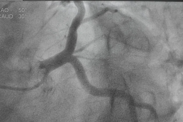 Coronary angiography, Coronary artery disease. Medical x-ray of heart disease. Healthcare and medical concept.