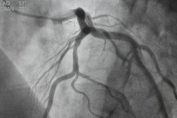 Angiografia Coronária Doença Arterial Coronária Radiografia Médica Doenças Cardíacas Conceito — Fotografia de Stock