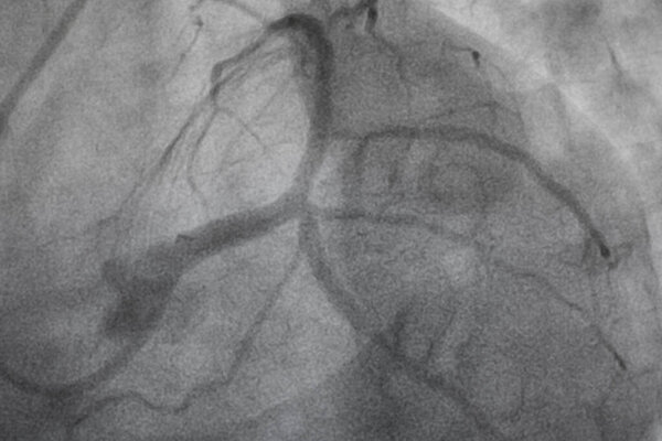 Coronary angiography, Coronary artery disease. Medical x-ray of heart disease. Healthcare and medical concept.