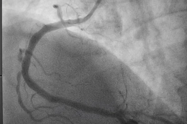 Coronary angiography, Coronary artery disease. Medical x-ray of heart disease. Healthcare and medical concept.