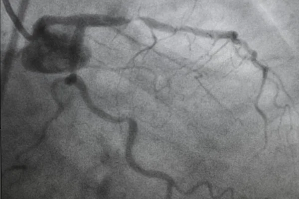冠状动脉造影 冠状动脉疾病 心脏病的医疗X光检查 保健和医疗概念 — 图库照片
