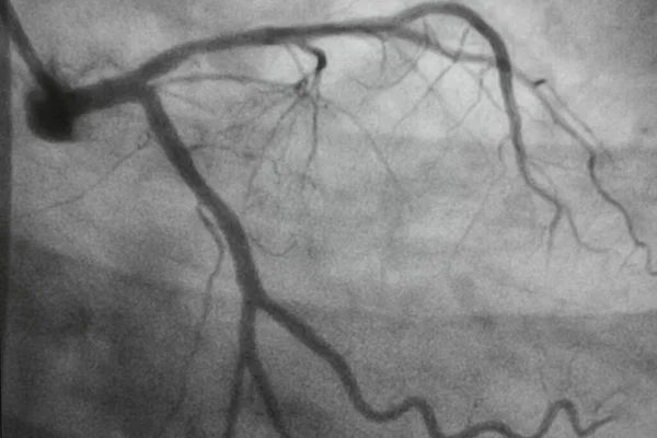 Coronary angiography, Coronary artery disease. Medical x-ray of heart disease. Healthcare and medical concept.