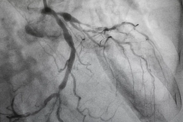 Coronaire Angiografie Coronaire Hartziekte Medische Röntgenfoto Van Hartziekten Gezondheidszorg Medisch — Stockfoto