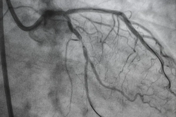 Angiografia Coronária Doença Arterial Coronária Radiografia Médica Doenças Cardíacas Conceito — Fotografia de Stock