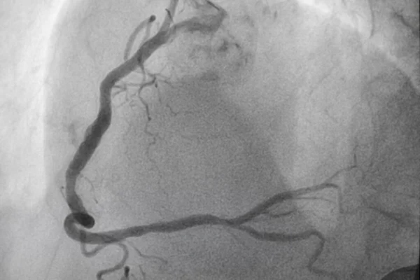 Coronary angiography, Coronary artery disease. Medical x-ray of heart disease. Healthcare and medical concept.