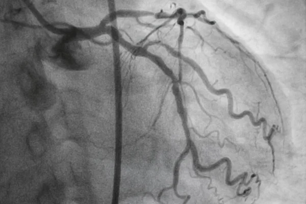 Aniografi Koroner Penyakit Arteri Koroner Ray Medis Penyakit Jantung Kesehatan — Stok Foto