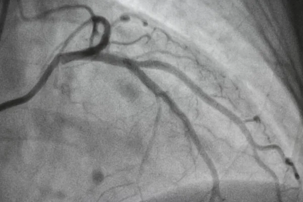 Coronary angiography, Coronary artery disease. Medical x-ray of heart disease. Healthcare and medical concept.