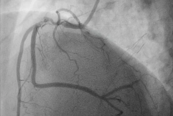 Coronary angiography, Coronary artery disease. Medical x-ray of heart disease. Healthcare and medical concept.