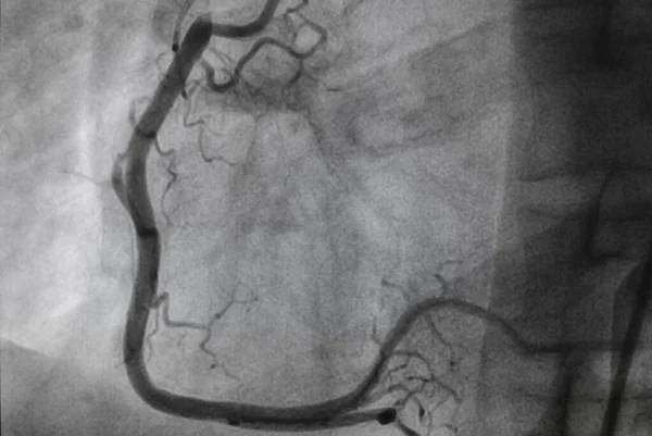 Angiografia Coronária Doença Arterial Coronária Radiografia Médica Doenças Cardíacas Conceito — Fotografia de Stock