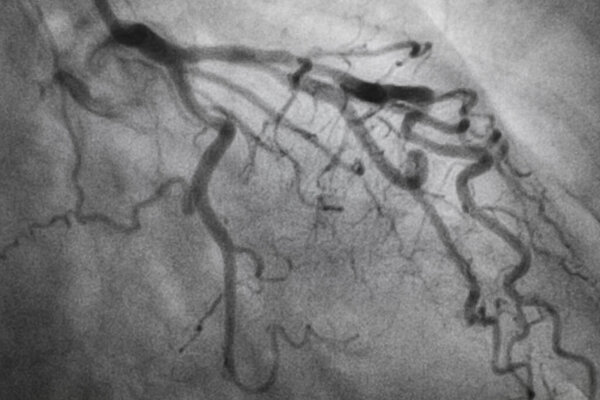 Коронарная ангиография, ишемическая болезнь. Медицинский рентген сердечных заболеваний. Здравоохранение и медицина.