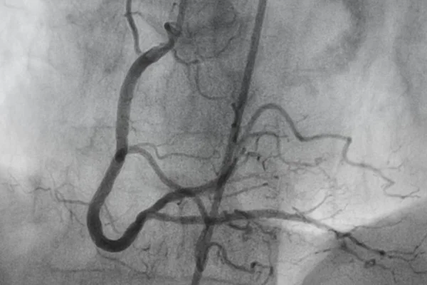 Angiografia Coronária Doença Arterial Coronária Radiografia Médica Doenças Cardíacas Conceito — Fotografia de Stock