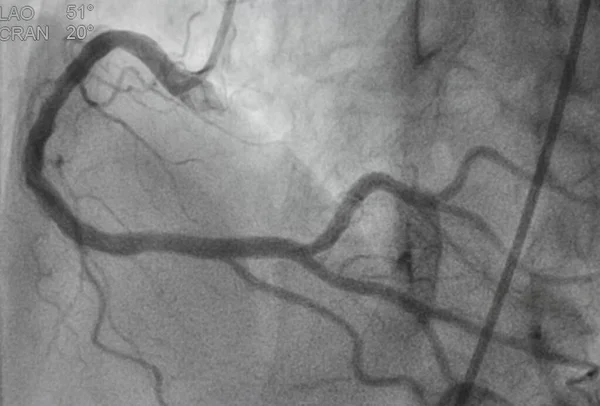 Koronarangiographie Koronare Herzkrankheit Medizinische Röntgenaufnahme Von Herzerkrankungen Gesundheitswesen Und Medizinisches — Stockfoto