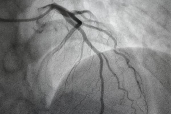 冠血管造影 冠動脈疾患 心臓病の医学X線 医療の概念 — ストック写真
