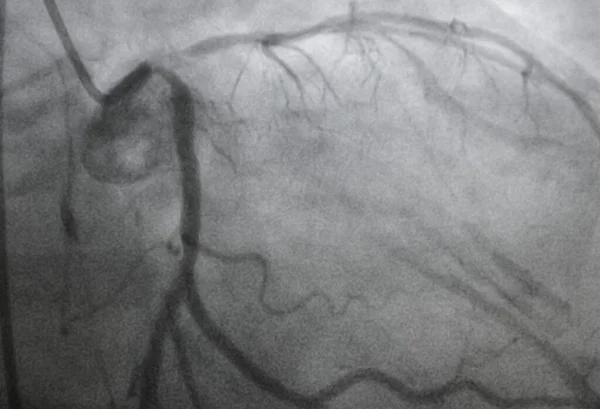 Coronary angiography, Coronary artery disease. Medical x-ray of heart disease. Healthcare and medical concept.