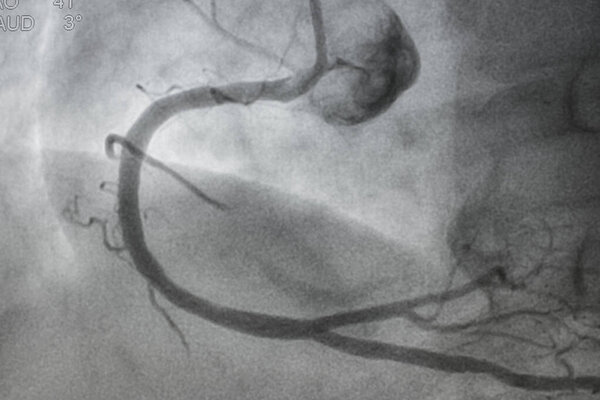 Коронарная ангиография, ишемическая болезнь. Медицинский рентген сердечных заболеваний. Здравоохранение и медицина.